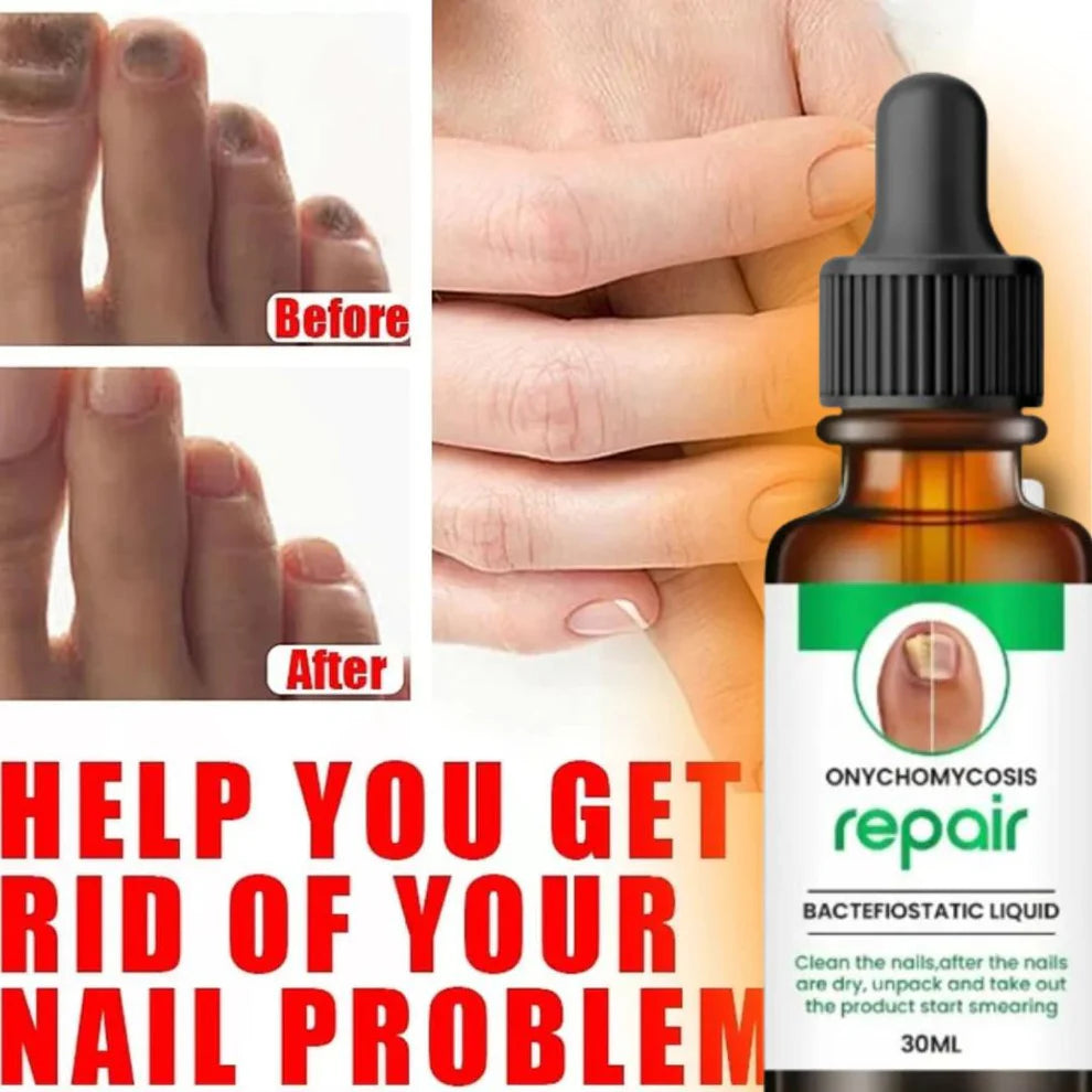 All In One Nail Serum 🔥 All Doctors 1st Choice 🔥(Buy 1 Get 1 Free)