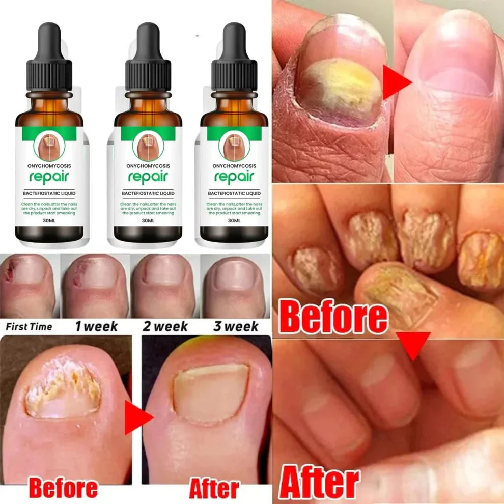 All In One Nail Serum 🔥 All Doctors 1st Choice 🔥(Buy 1 Get 1 Free)