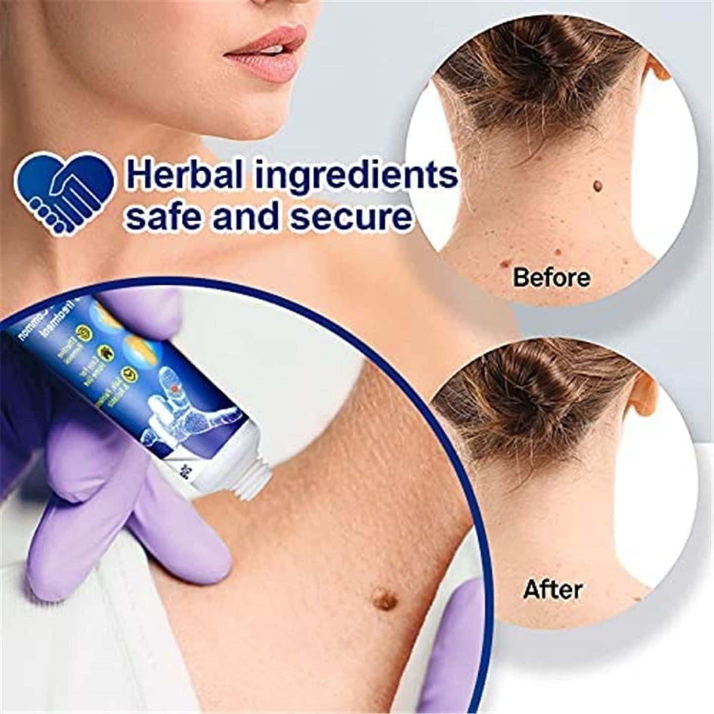 Instant Warts Removal Cream